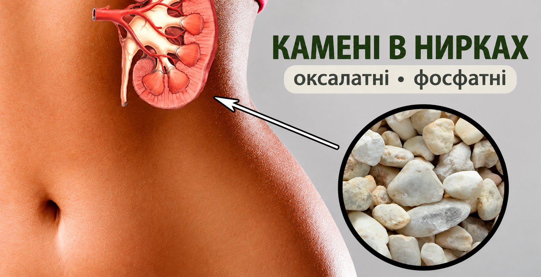 Камені в нирках — оксалатні та фосфатні камені
